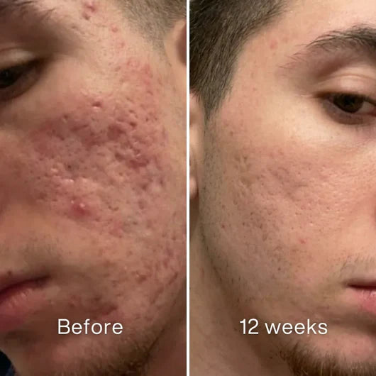 Clinical Acne Scar Remodeling Stick™